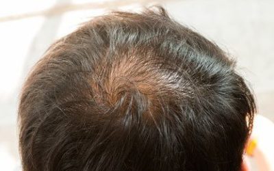 PRP: TRATTAMENTO PER LA RICRESCITA DEI CAPELLI