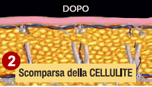 Trattamento Cellulite Dopo