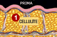 Trattamento Cellulite Prima